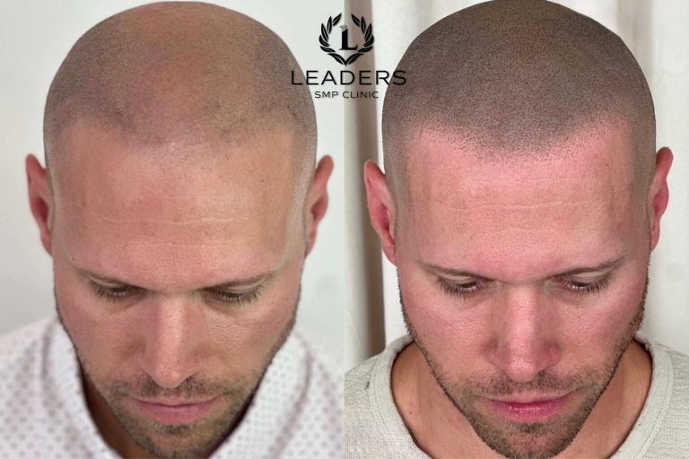 Scalp Micropigmentation for Bald Men
