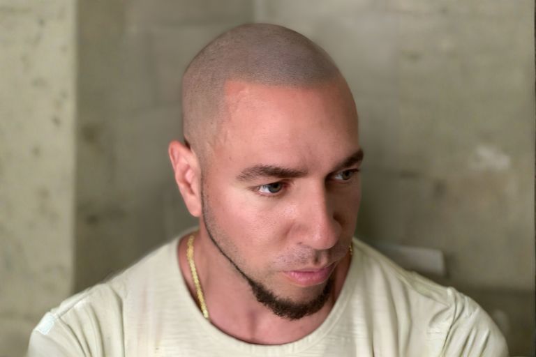 Top Benefits of Scalp Micropigmentation for Men and Women