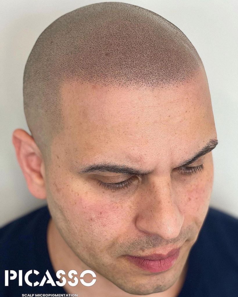Scalp Micropigmentation Chicago