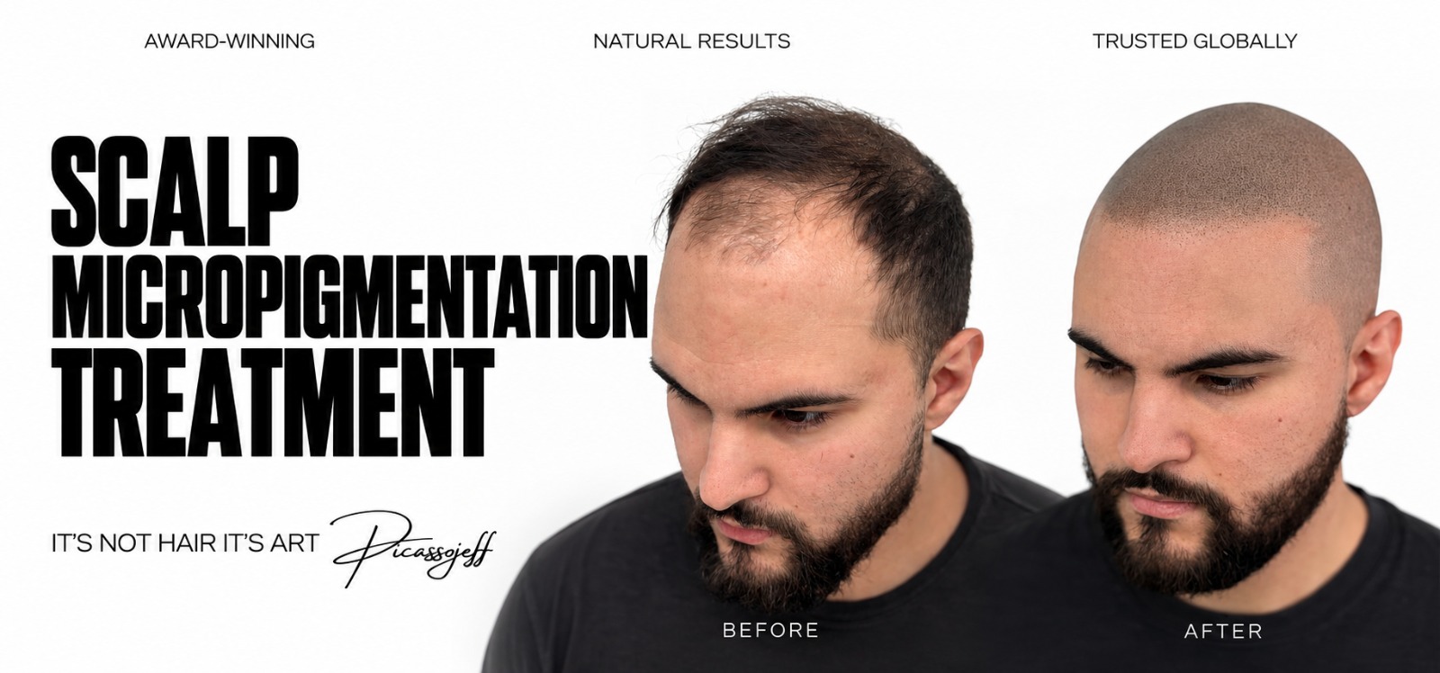 Scalp micropigmentation treatment